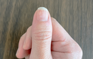 爪が荒れた親指の写真
