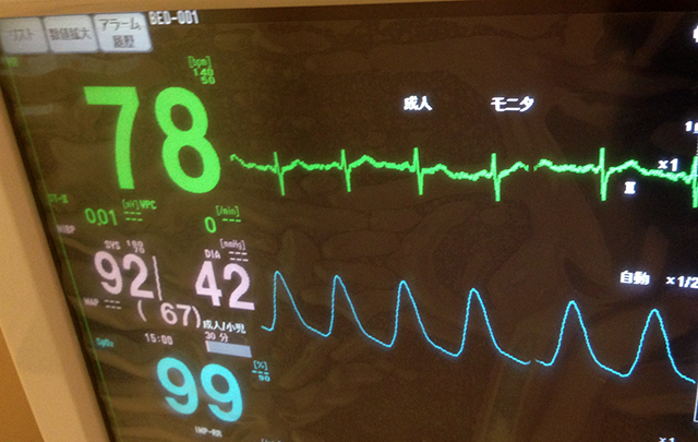 心拍数「78」を表示する心電図モニターの画像