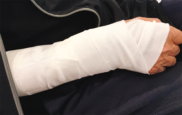 骨折した手首を包帯で処置した画像
